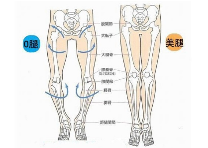 O型腿的矫正方法有哪些