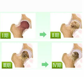 如何确诊是否患有股骨头