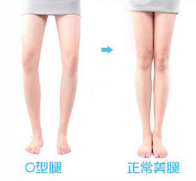 O型腿患者常见的症状