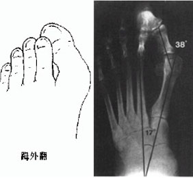 拇外翻矫正注意事项