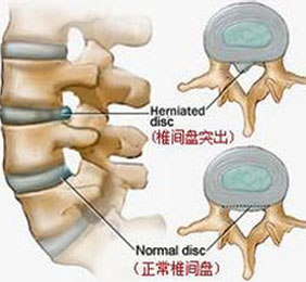 特色治疗之腰椎间盘突出