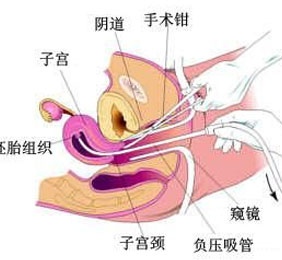无痛人流后注意事项有哪些