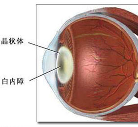 白内障有哪些症状？