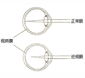 高度近视的注意事项有哪