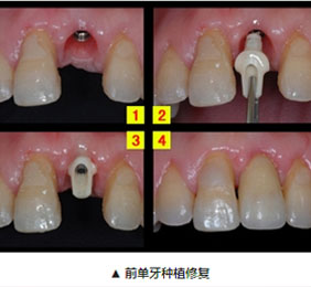 种植牙带给你全新的概念