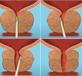 前列腺增生的微创治疗