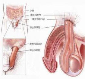 认识疝气是什么病