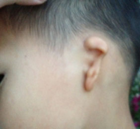 什么是耳廓畸形？