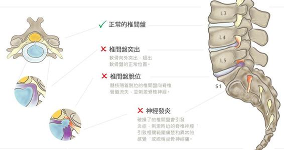 如何不开刀治疗腰椎滑脱