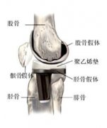 什么是风湿性关节炎？