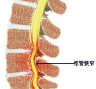 椎管狭窄症临床表现