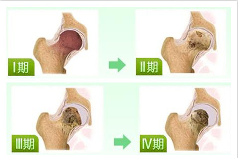 如何确诊是否患有股骨头坏死