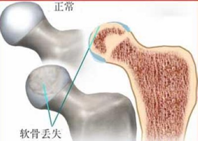 不同阶段的股骨头坏死都有什么表现