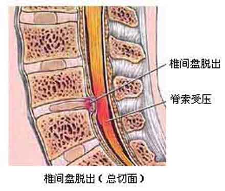 造成腰椎间盘滑脱的原因是什么