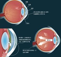 青光眼