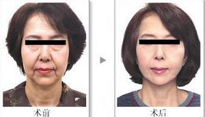 脸部除皱案例分析