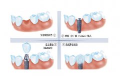 哪些人适合做种植牙?