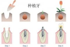 种植牙手术前6个须知