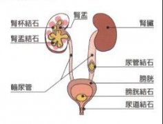 尿路结石的诊断鉴别