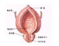 腺性膀胱炎怎么治？