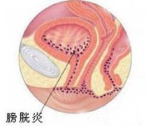 憋尿会导致膀胱炎吗？