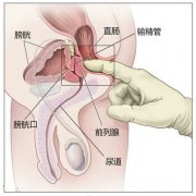 前列腺炎的尿液检查