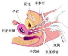 无痛人流手术的特点