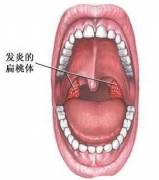 我院专家教您如何诊断咽