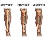 X线检查对骨折的诊断和治