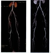 下肢血管CTA
