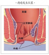 痔疮是什么样?