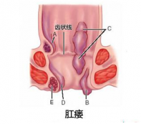 肛瘘的发病原因