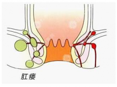 肛瘘术后饮食注意事项