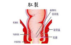 肛裂的五大预防方法