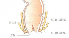 肛裂出血怎么办?