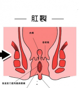 肛裂会导致哪些危害呢？