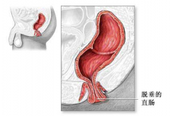 如何预防直肠脱垂