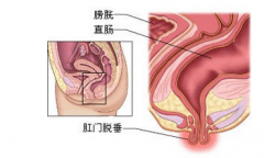 直肠脱垂的日常护理